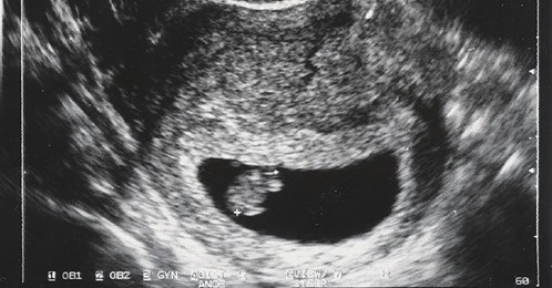 17 февраля 2021 г
В штате Теннесси  хотят внести законопроект,  который позволит биологическим отцам  запретить женщине, которая беременна своим еще не родившимся ребенком, сделать аборт.