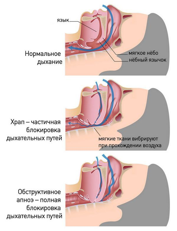 Схема наступления апноэ