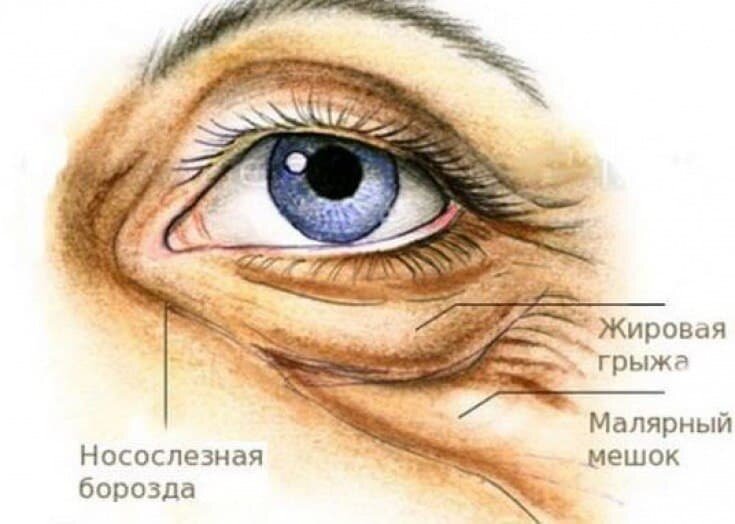 Мешки под глазами