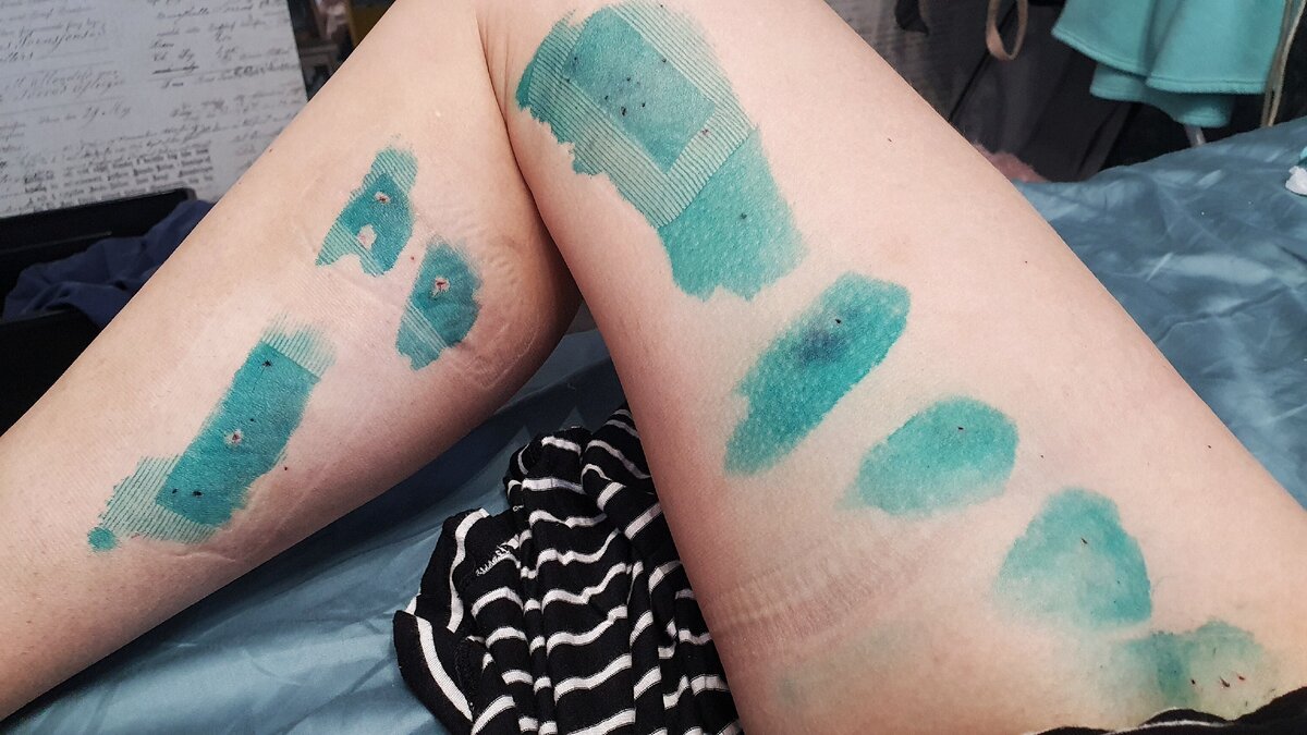 Моя ножка через 2 дня после операции