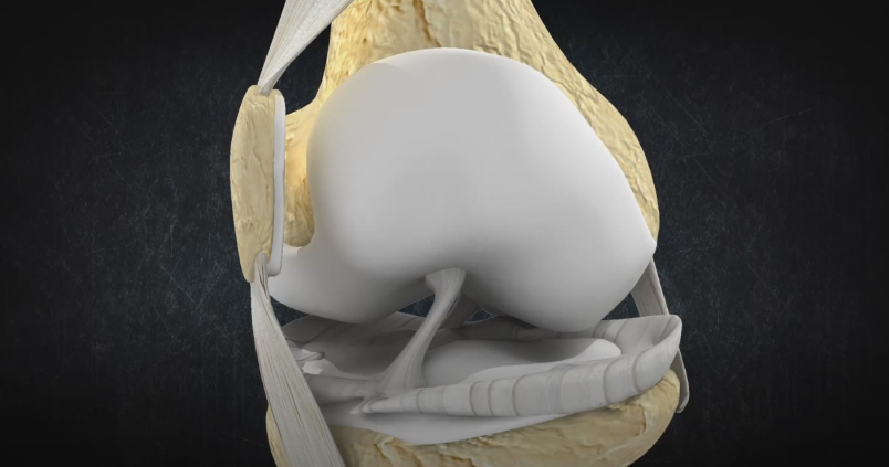 Пример: ВЫВИХ НАДКОЛЕННИКА. смещение. 