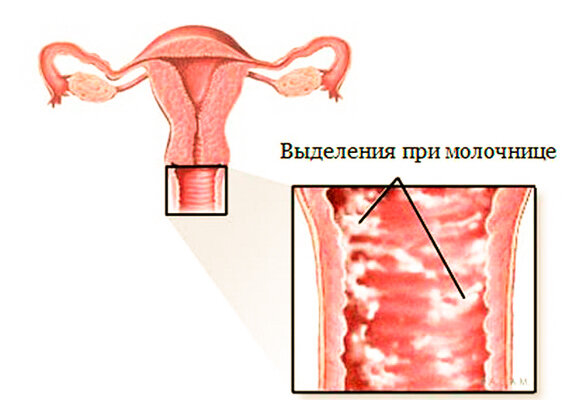 Выделения при вагинальном кандидозе