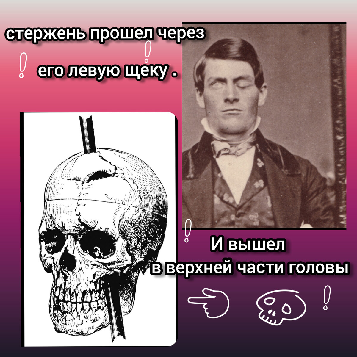 Травма Финеаса Гейджа: самый невероятный случай в медицине | Медицинские  байки /Все обо всем. | Дзен