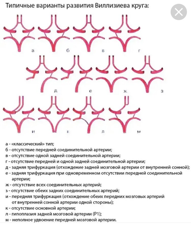 Схема сосудов Виллизиева круга. Варианты строения Виллизиева круга. Вариант развития Виллизиева круга головного. Аномалии развития передней мозговой артерии.