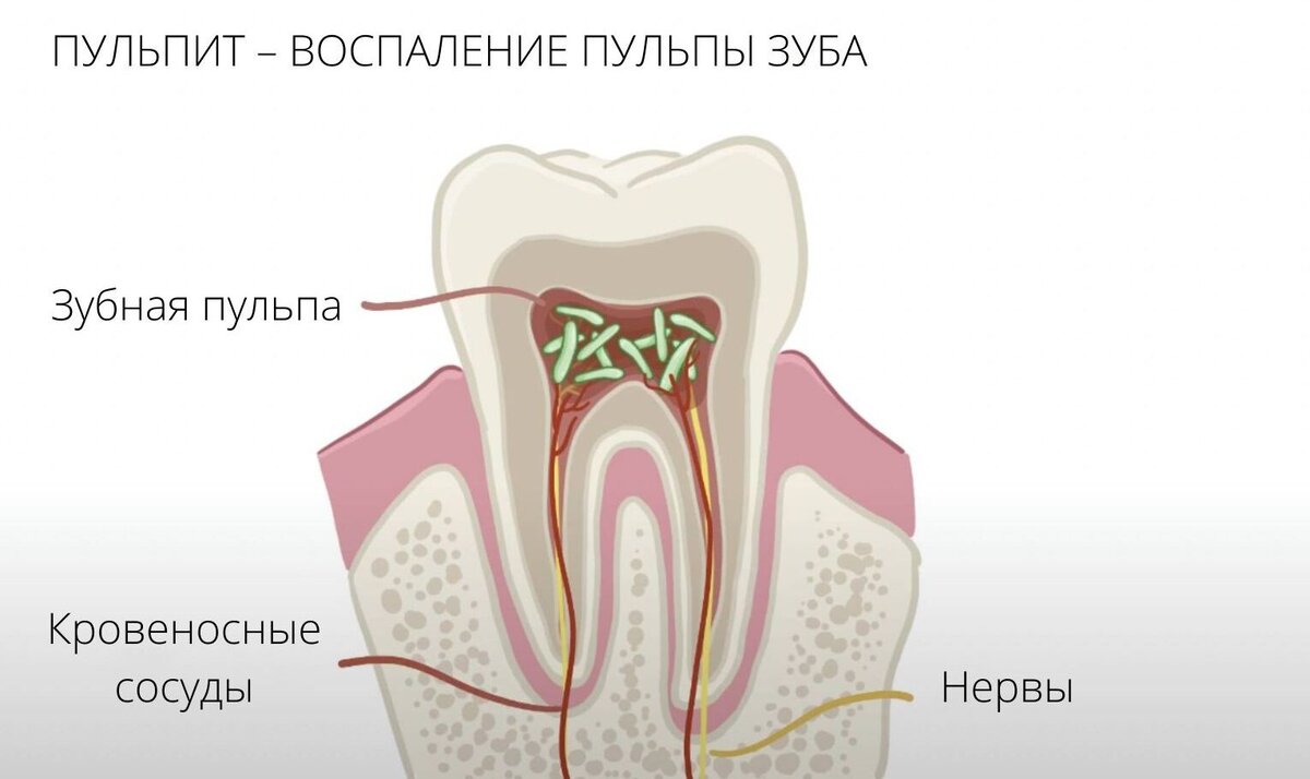 Удаление нерва зуба температура