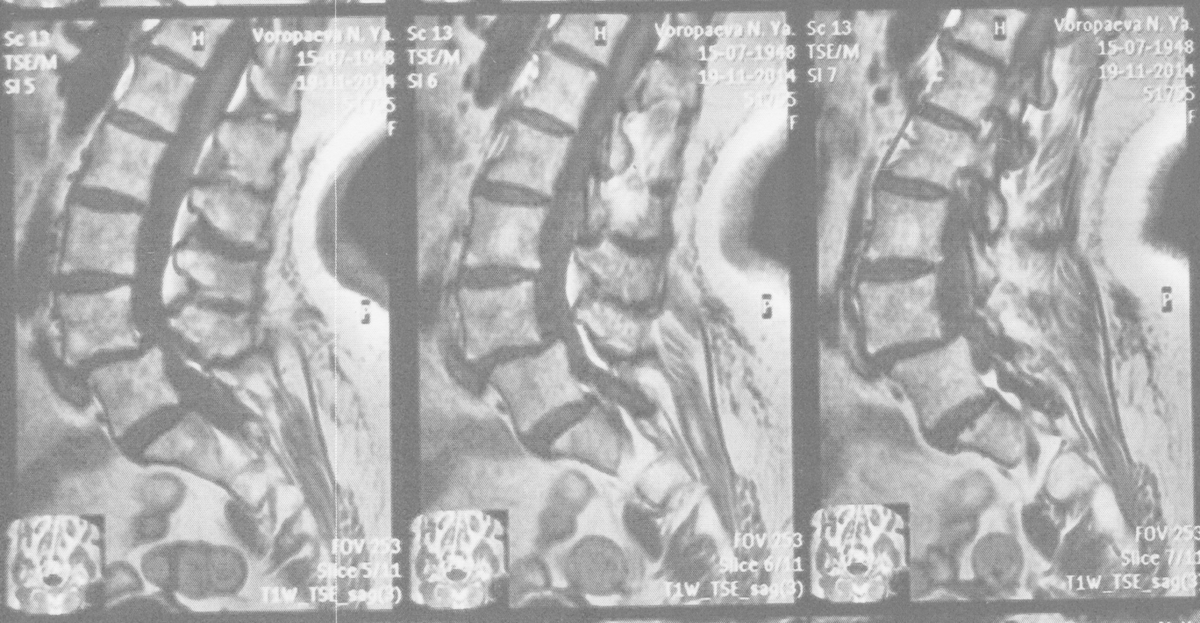 Снимок позвоночника с передним спондилолистезом ("антелистезом"). собственные наблюдения автора
