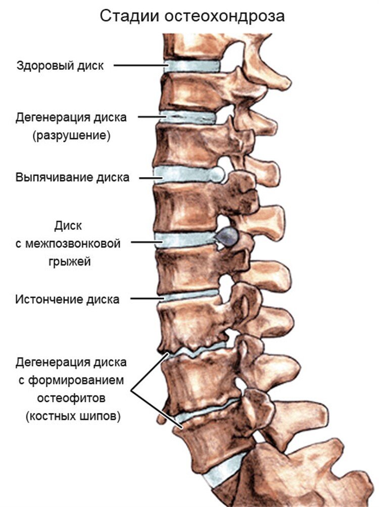 Клиническая картина остеохондроза позвоночника