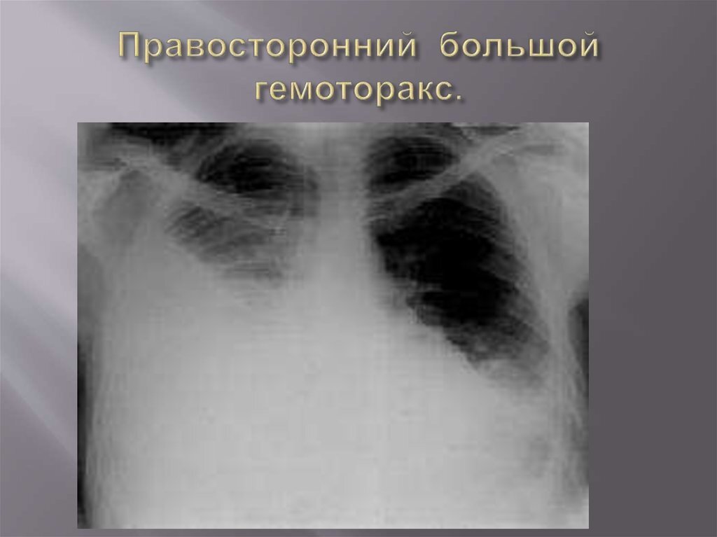 Гемоторакс карта вызова