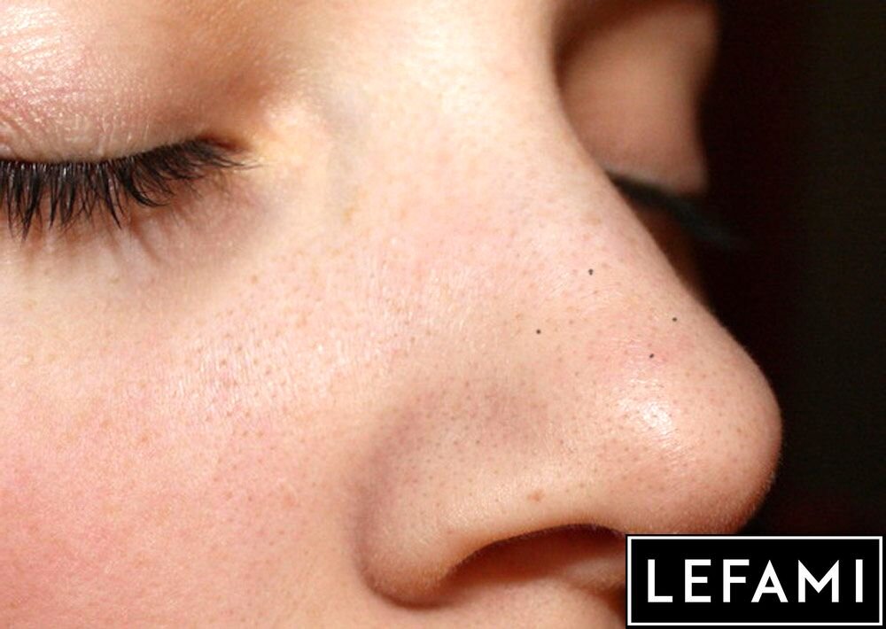 Черные точки на лице: причины появления комедонов, симптомы и лечение акне, процедура чистки кожи