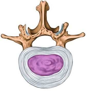 На последних двух фотографиях изображён здоровый межпозвоночный диск и с разрывом фиброзного кольца