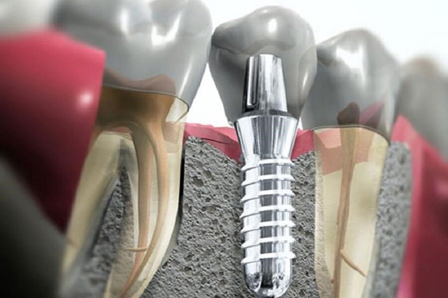Дентальная имплантация