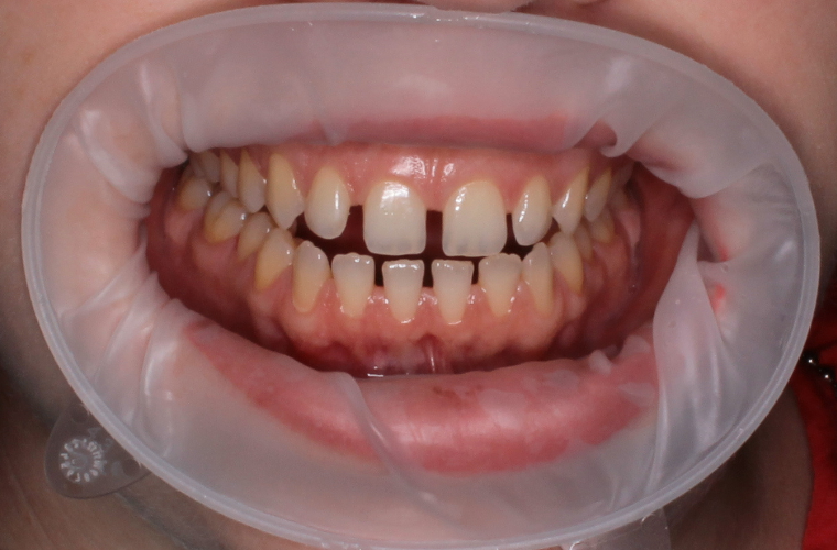 Мамелоны появляются еще во время формирования постоянных резцов.Иногда эти углубления достаточно заметные, что и создает волнистый вид у режущего края зубов.