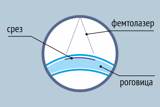 толщина роговицы для лазерной коррекции. толщина роговицы в норме для лазерной коррекции. толщина роговицы для лазерной коррекции зрения таблица. эксцентриситет роговицы. толщина роговицы после ласик.
