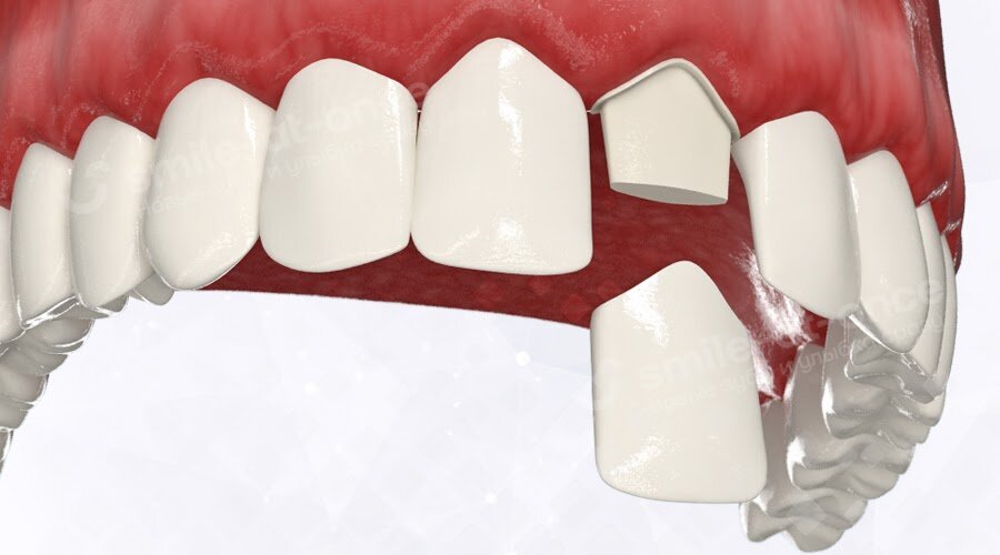 Ошибки в стоматологии:поставили пломбу зуб раскололся