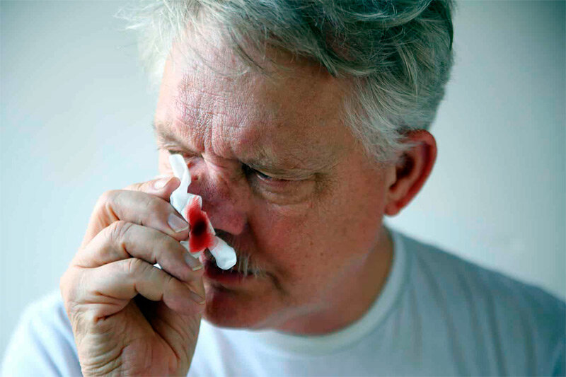 Причины носового кровотечения