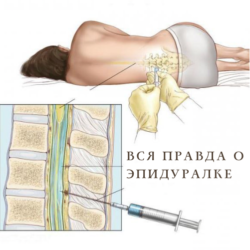 Вся правда о эпидуралке.