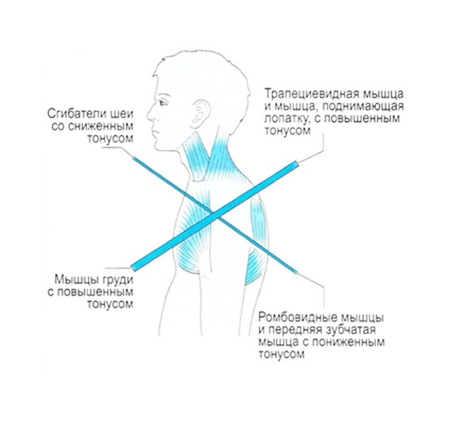 Верхний перекрестный синдром