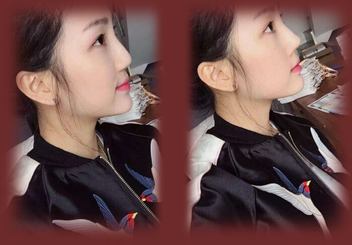 Изменение формы кончика носа с помощью вкладыша