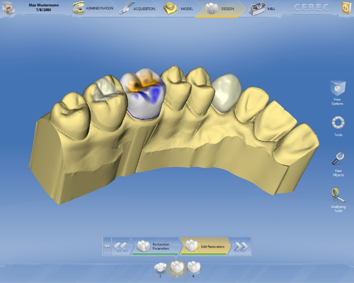 Зубы из цифрового цирка. Моделирование на церек. 3d протезирование CEREC. CAD cam CEREC зубы. CAD/cam моделировка.