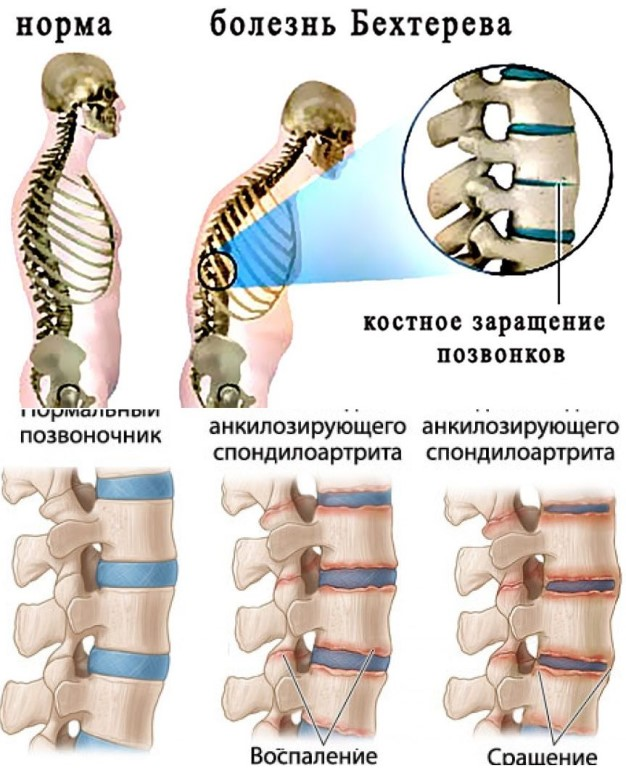 Заболевание позвоночника причины