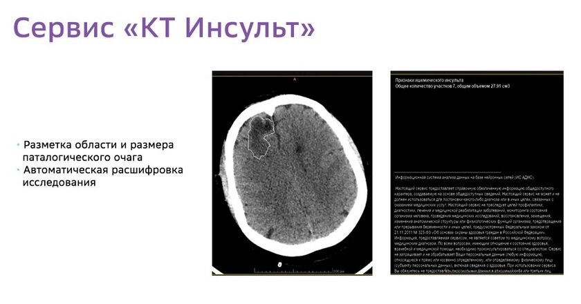 Этот сервис в настоящее время запущен в работу и активно используется врачами в ежедневной клинической практике. Обученная на алгоритмах нейросеть умеет за считанные минуты «прочитать» снимок КТ, найти на нем участки патологических изменений, отметить их и выдать точные размеры, типологические характеристики и расположение зоны инсульта.