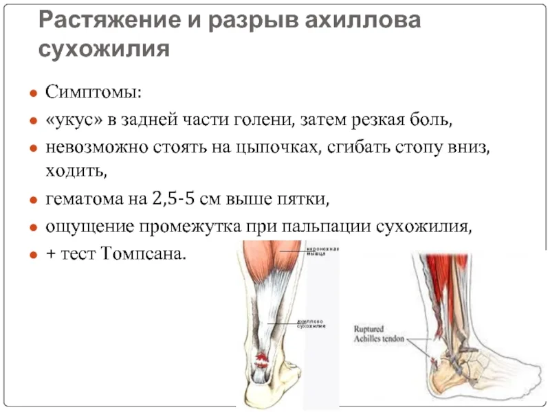 Растяжение ахиллова сухожилия УЗИ. Ахиллово сухожилие растяжение. Ахиллово сухожилие разрыв ахиллова сухожилия. Ультразвуковая анатомия ахиллова сухожилия.