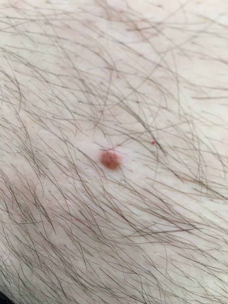 вторая - на коже живота (к сожалению, снимок не лучшего качества)