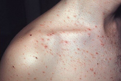 Акнеподобная сыпь