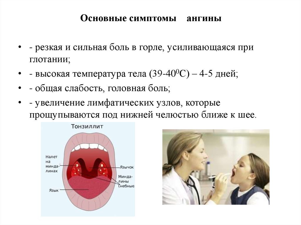 Ангина/воспаление горла