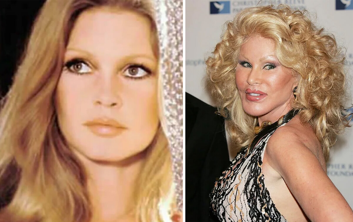 Фото из сети Интернет
Джослин Вильденштейн, жертва пластической хирургии