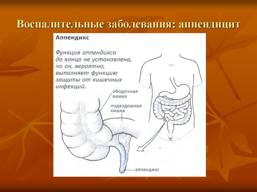 Диагностика острого аппендицита на УЗИ органов брюшной полости
