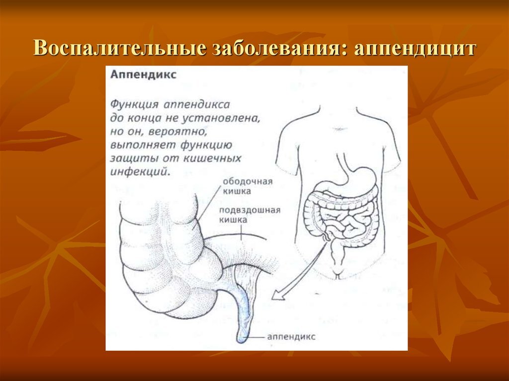 Колики аппендицит