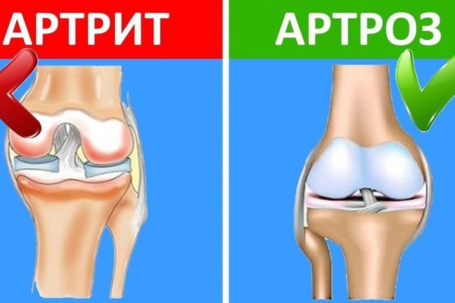 Артрит