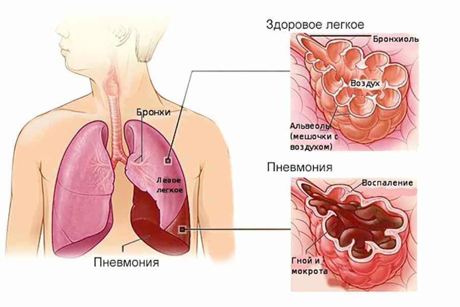 Поражение лёгкого пневмонией