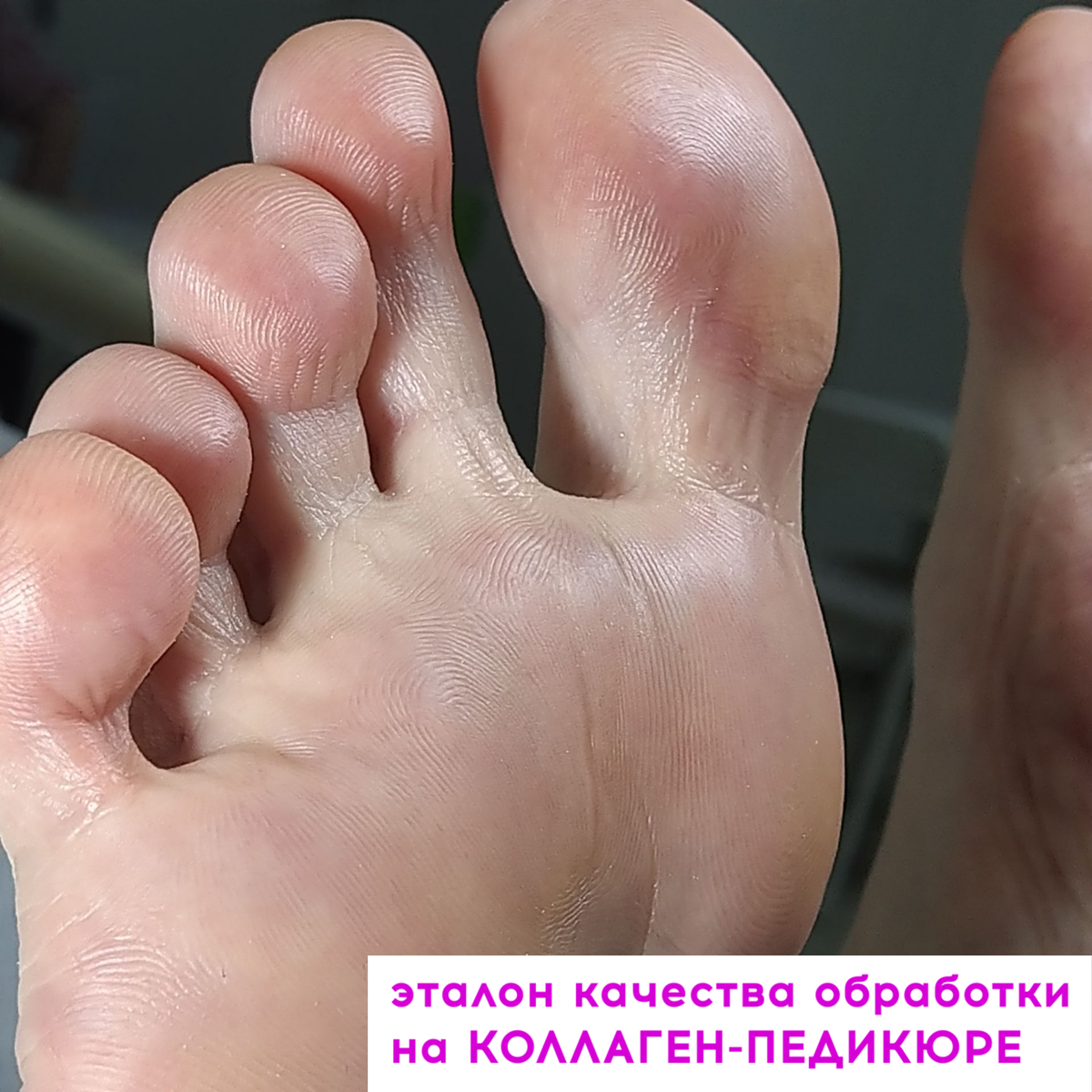 Идеальный чистый рисунок папиллярных линий стоп после КОЛЛАГЕН-ПЕДИКЮРА