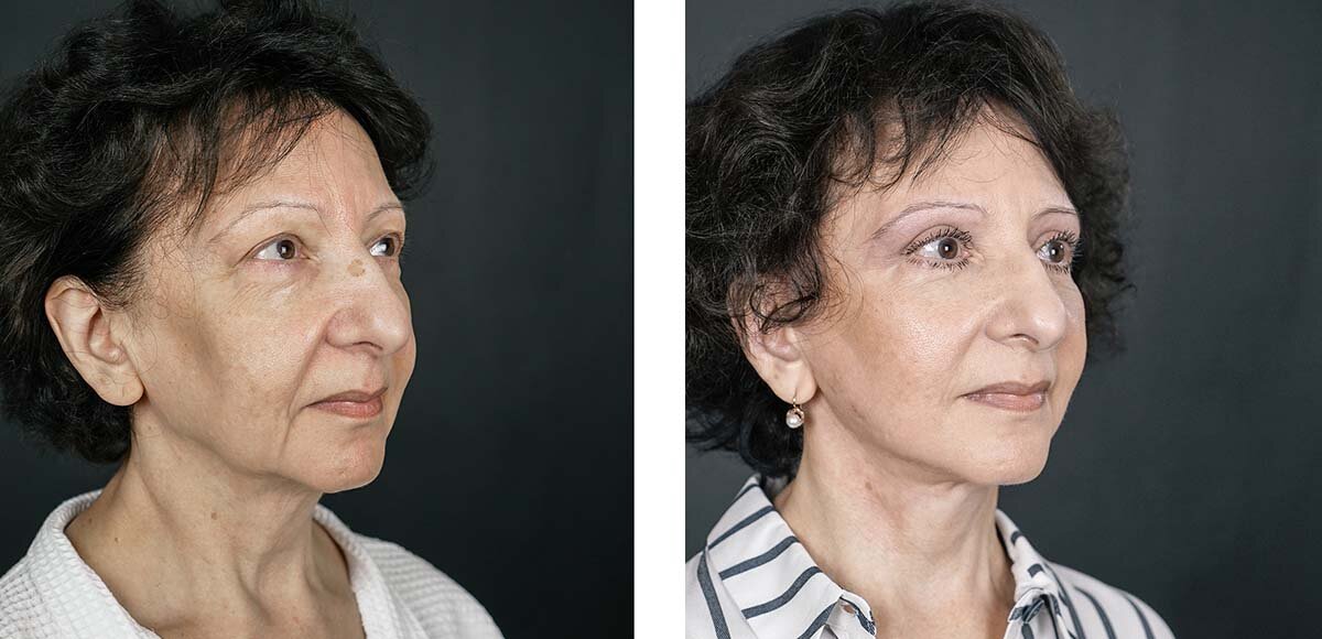 Результат круговой подтяжки лица и верхней блефаропластики.