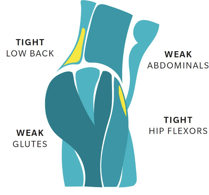 слабые ягодичные и мышцы пресса и укороченные сгибатели бедра и разгибатели спины