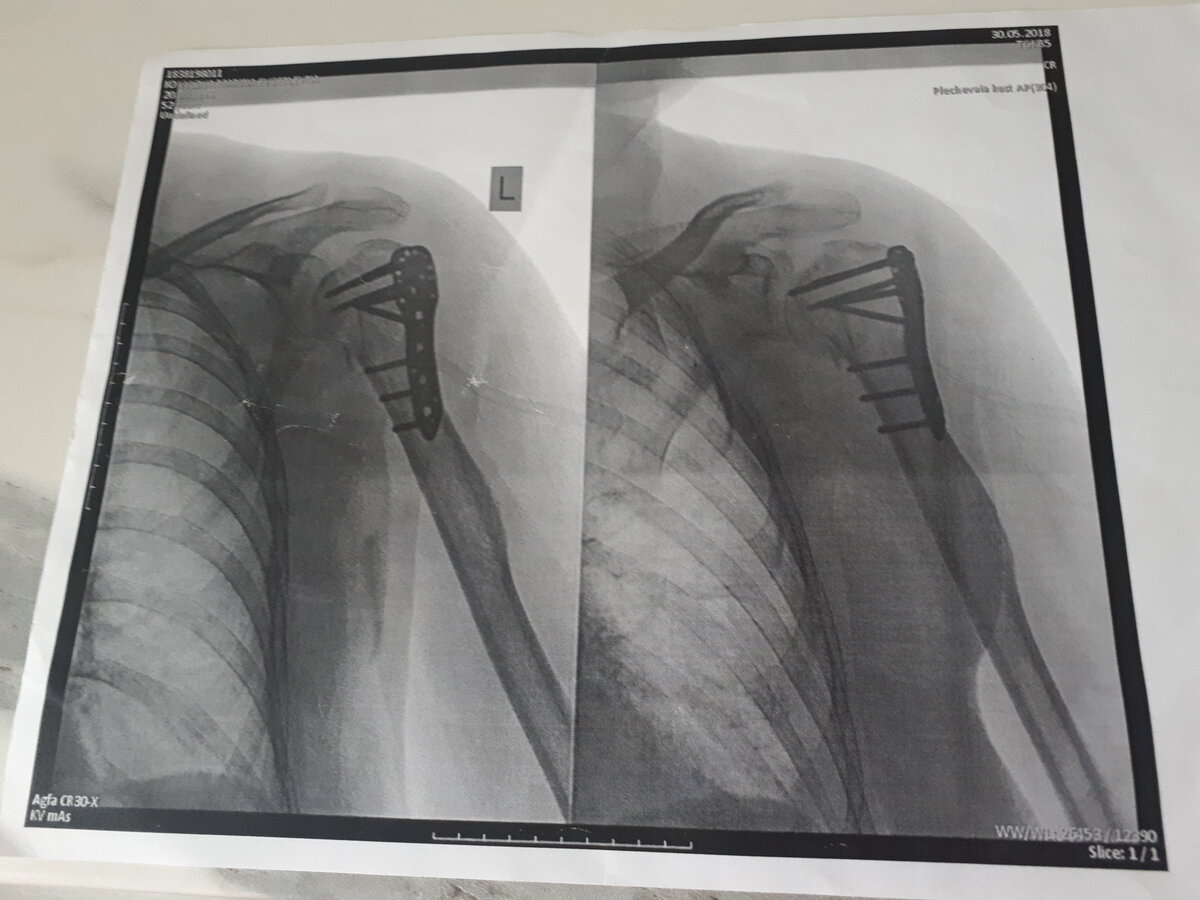 Снимок моего плеча после операции с установленным металлоостеосинтезом. Фото из личного архива.