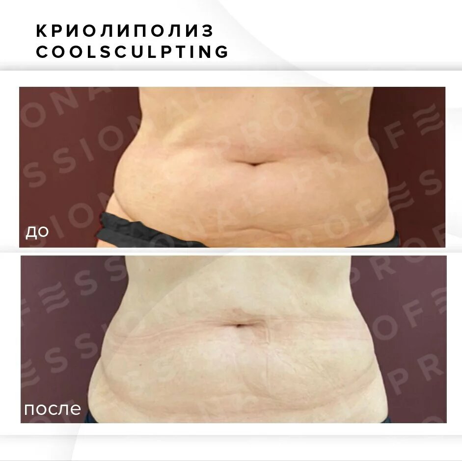 ИМЕЮТСЯ ПРОТИВОПОКАЗАНИЯ, НЕОБХОДИМА КОНСУЛЬТАЦИЯ СПЕЦИАЛИСТА