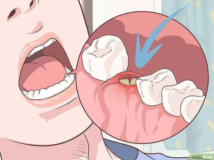 Кюретаж лунки после удаления зуба, альвеолите.