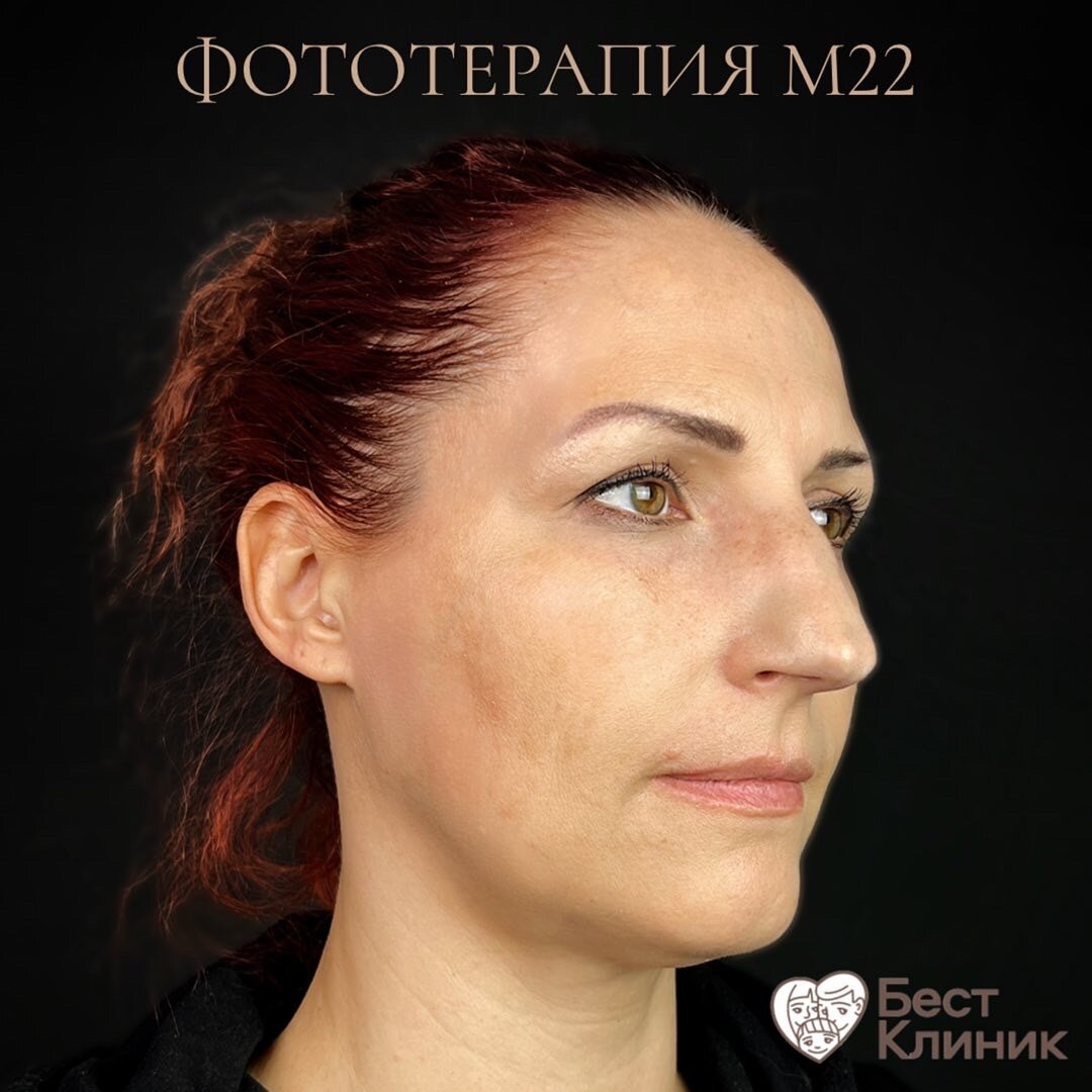 Результат после фототерапии