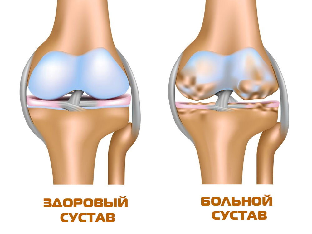 Народные средства при артрозе коленного сустава | 35+ | Дзен