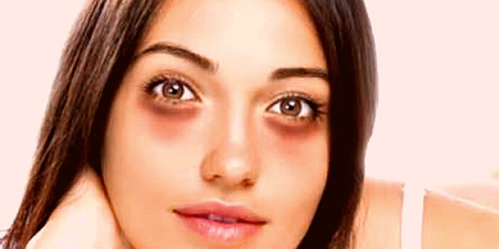 Красный оттенок кругов под глазами чаще бывает при аллергии.