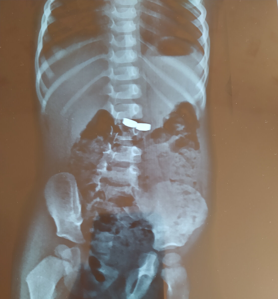 Батарейки хорошо видны на рентгеновском снимке