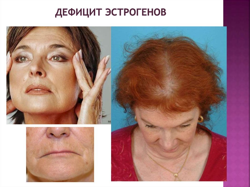 На фото: Дефицит эстрогенов