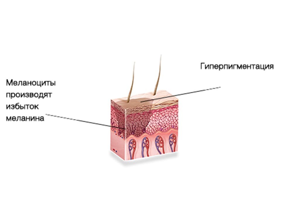 Что такое меланоциты в волосе