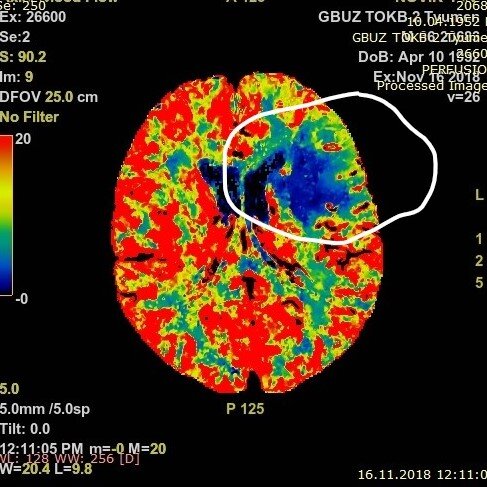 На схеме синим цветом - зона инсульта головного мозга