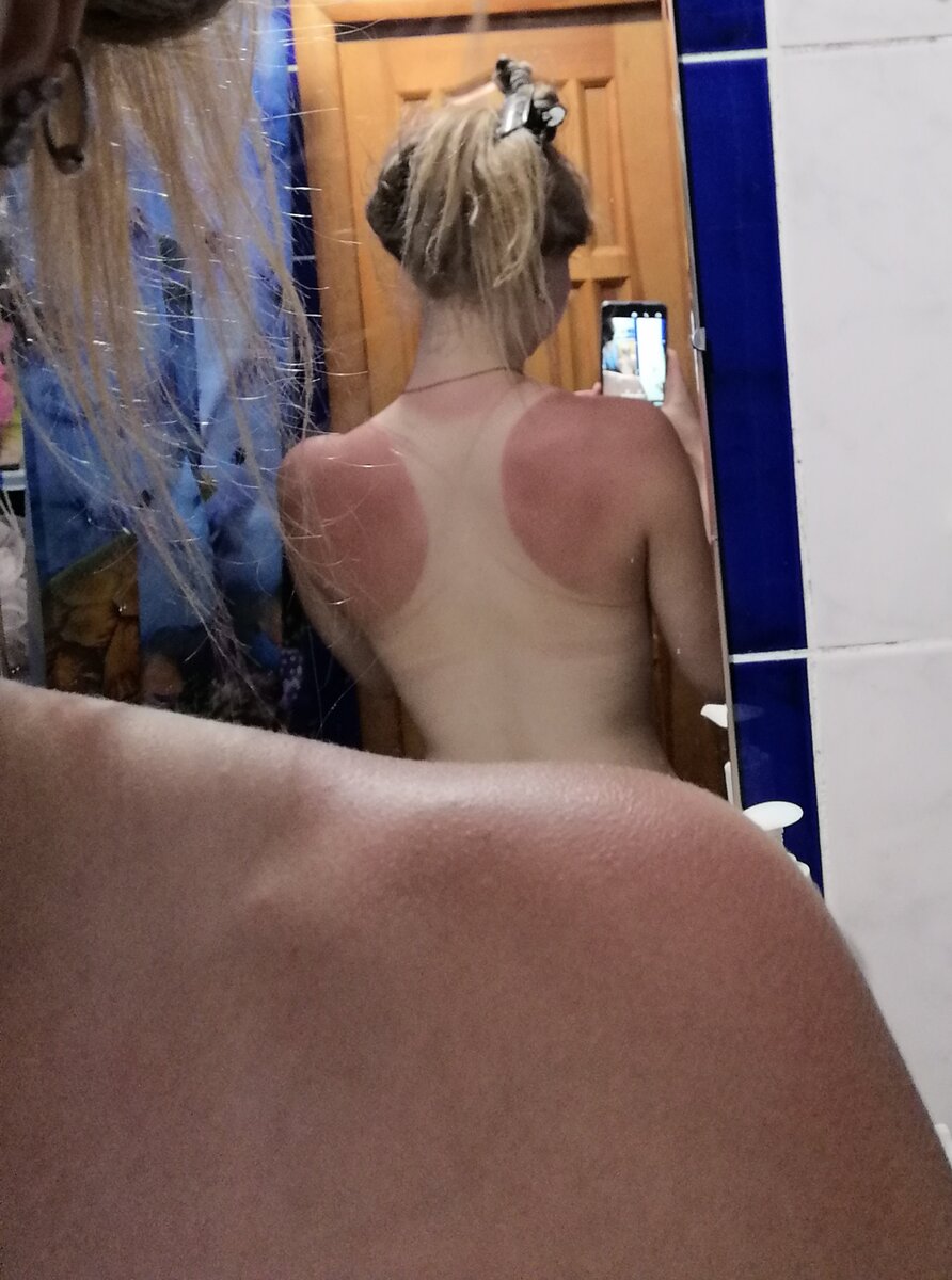 Обгорела после первое езды на велике в майке