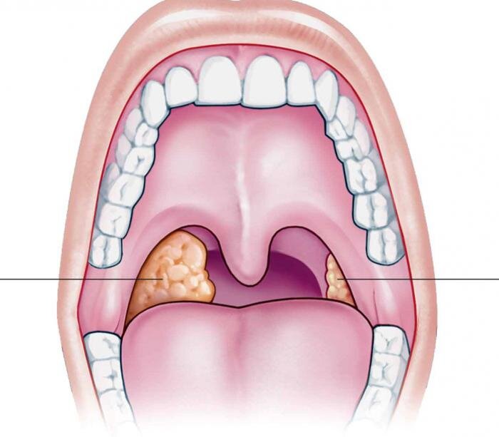 Камень тонзиллит фото Гной всего лишь армия погибших лейкоцитов, которые стойко сражались за ваше здор