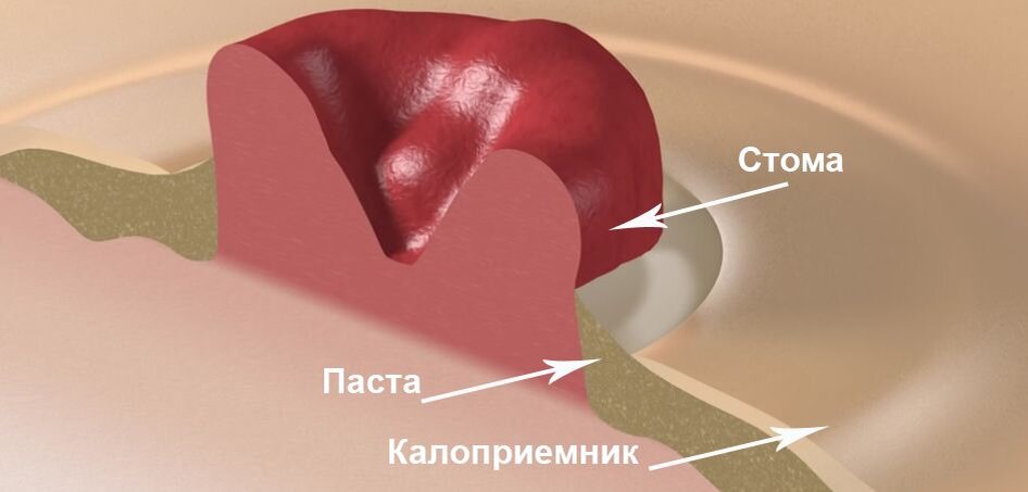 Как правильно снять калоприемник